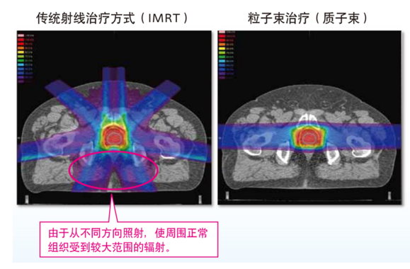 质子治疗(图1)