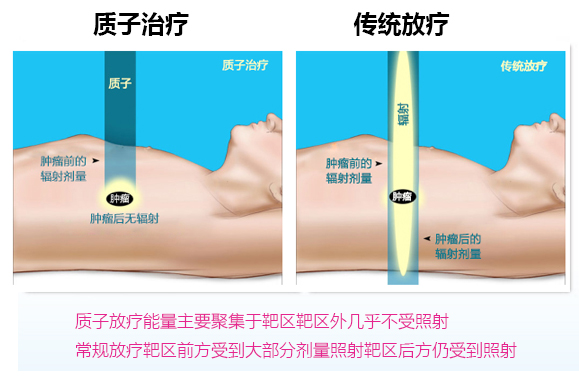 质子治疗(图2)