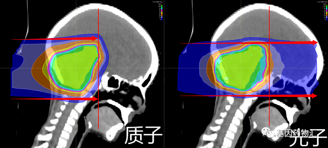 质子放疗和传统放疗对比
