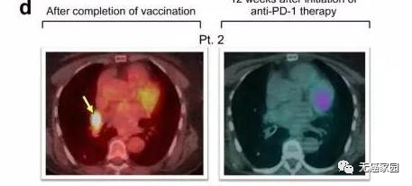 NeoVax疫苗治疗效果