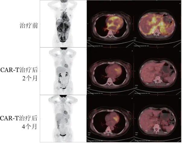 CNCT19治疗复发难治性急性淋巴细胞白血病的效果