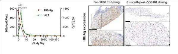 TCR-T疗法SCG101治疗肝癌HBsAg的变化