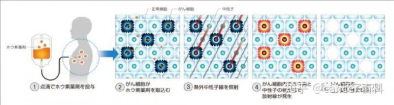 硼中子俘获疗法治疗流程