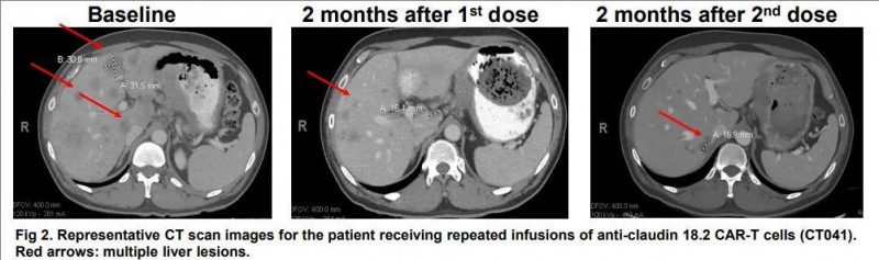 MD安德森癌症中心公布的CAR-T治疗胃癌的效果