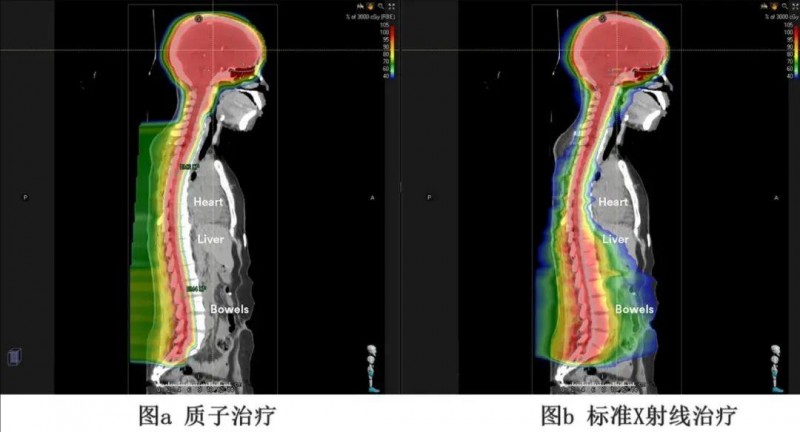 头部和脊柱部位质子和X射线治疗对比