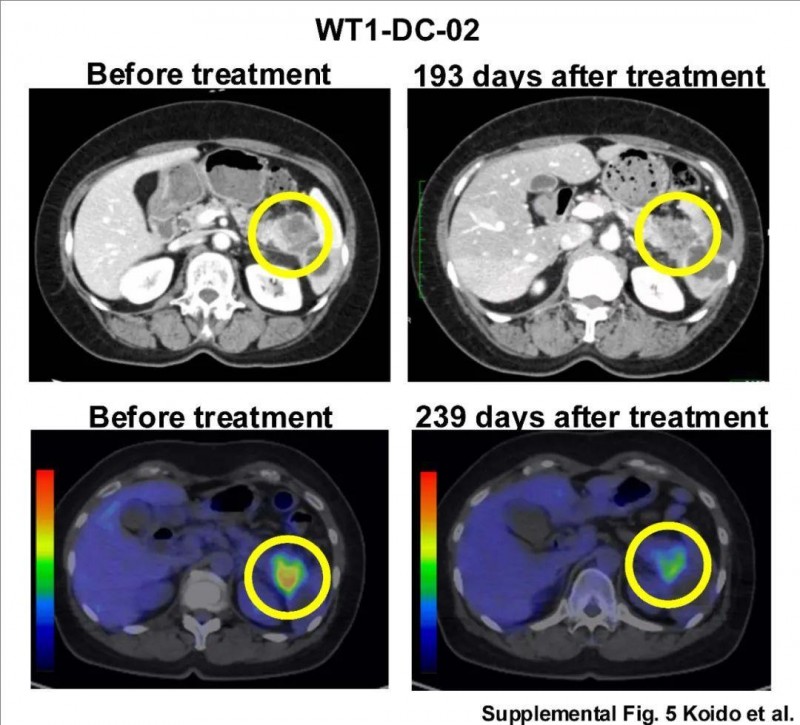 WT1-DC疫苗联合化疗治疗转移性胰腺导管腺癌的效果