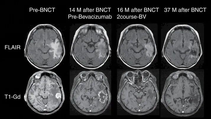 BNCT治疗胶质母细胞瘤的效果