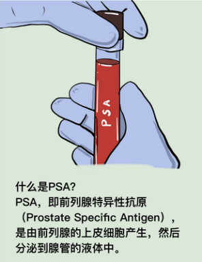 早期前列腺癌术后五年生存率超99%,但是还需警惕复发,这几件