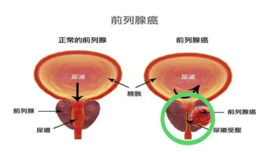 早期前列腺癌术后五年生存率超99%,术后还需要做些什么、需要