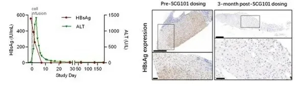 SCG101-TCR-T疗法治疗肝癌的HBV感染改善数据