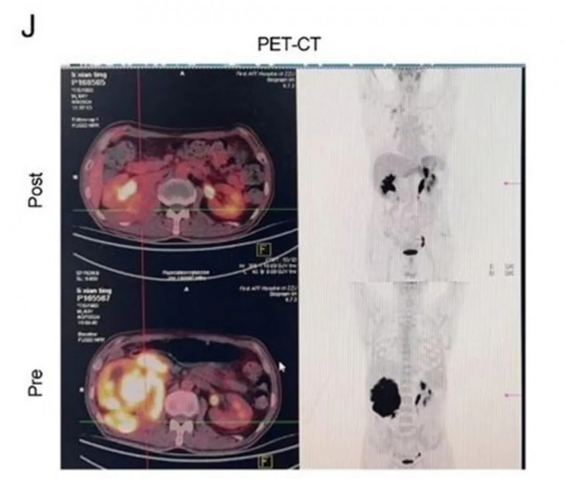 CART细胞疗法治疗淋巴瘤的效果