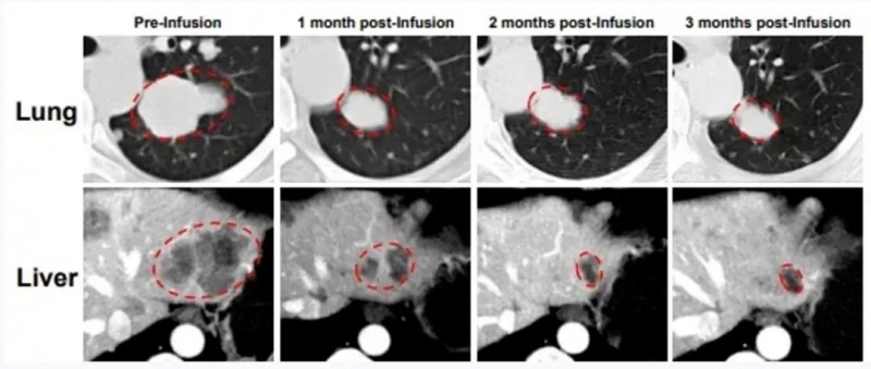 GC203治疗卵巢癌的效果