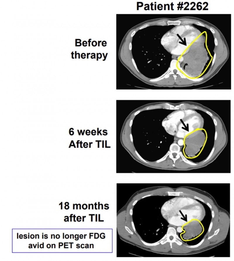 TIL细胞疗法治疗黑色素瘤的效果