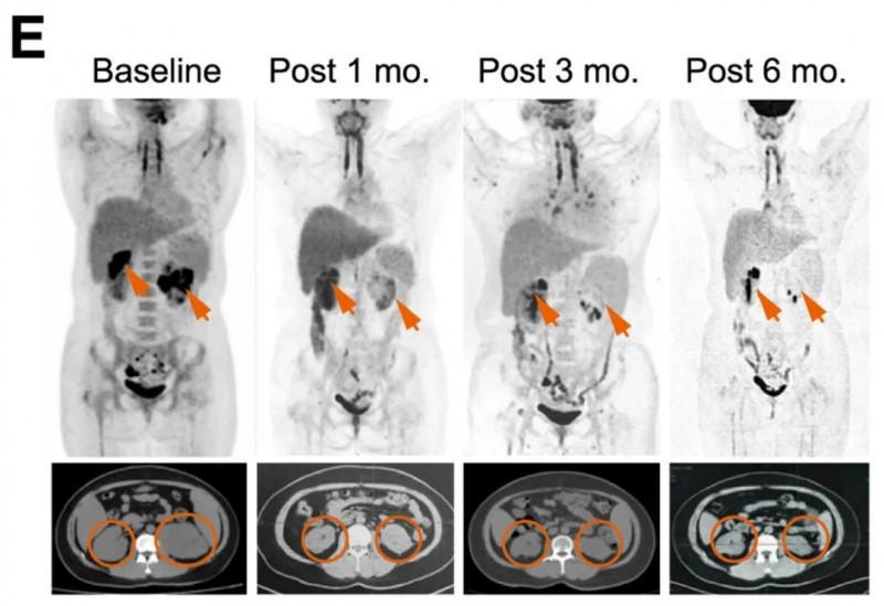 CART细胞疗法治疗难治性淋巴瘤的效果