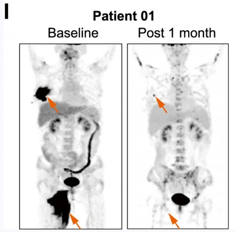 CART细胞疗法治疗难治性淋巴瘤的效果