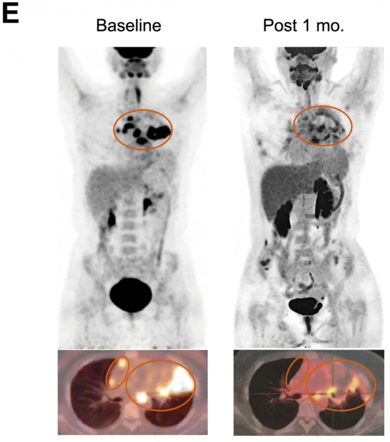 CART细胞疗法治疗难治性淋巴瘤的效果