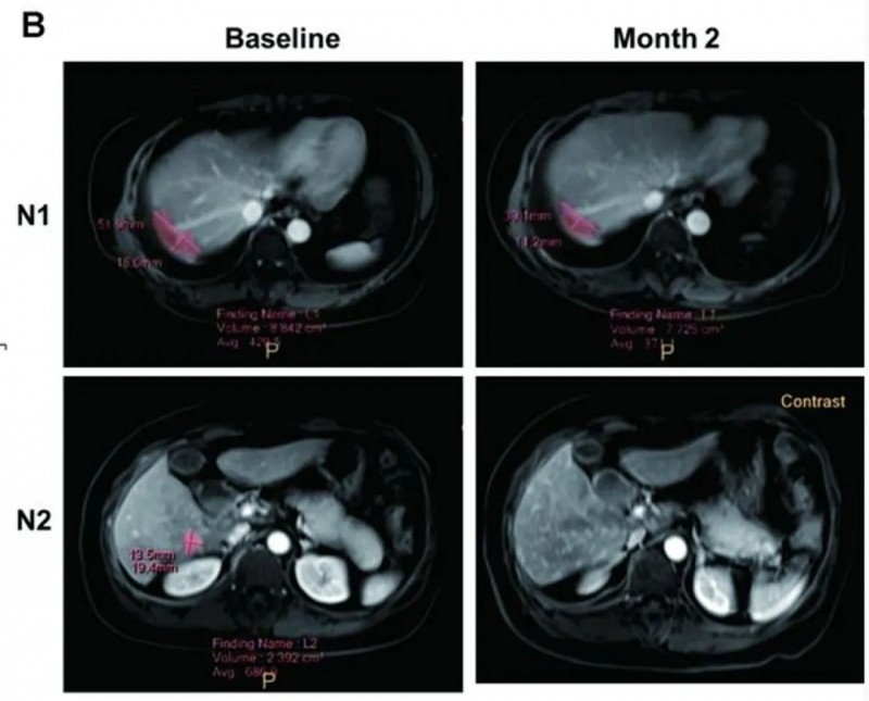 CART细胞疗法治疗卵巢癌的效果