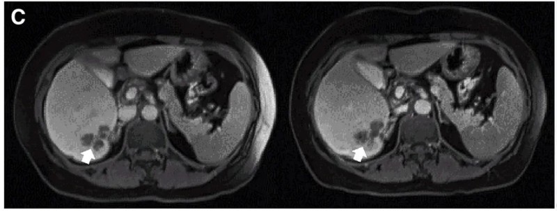 CART细胞疗法治疗结直肠癌的效果