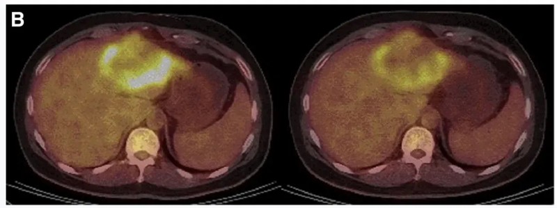 CART细胞疗法治疗结直肠癌的效果