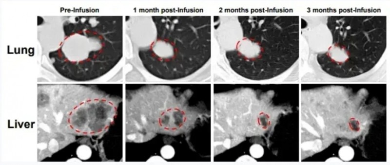 TIL细胞疗法治疗卵巢癌的效果