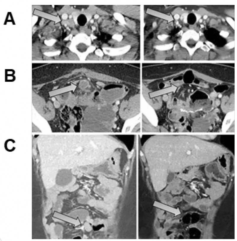 TIL细胞疗法治疗结直肠癌的效果