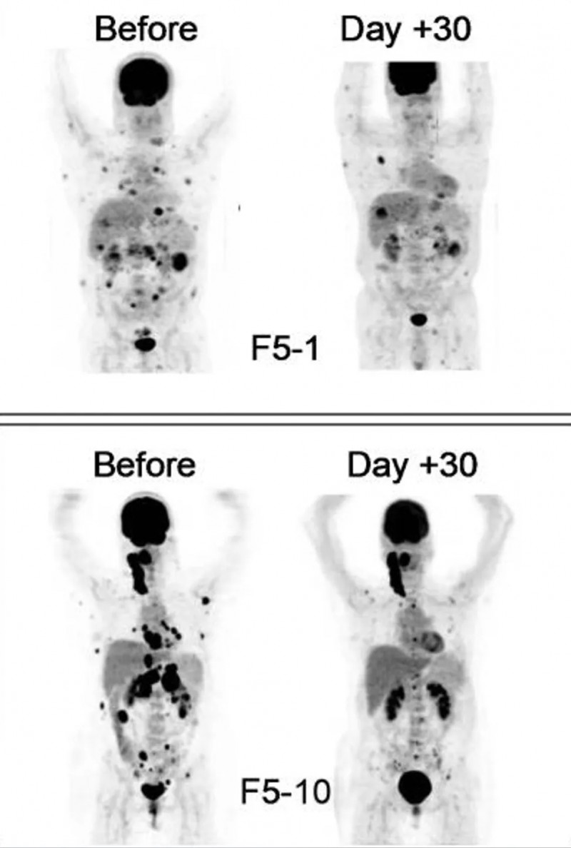 TCR-T联合DC疫苗治疗黑色素瘤的效果