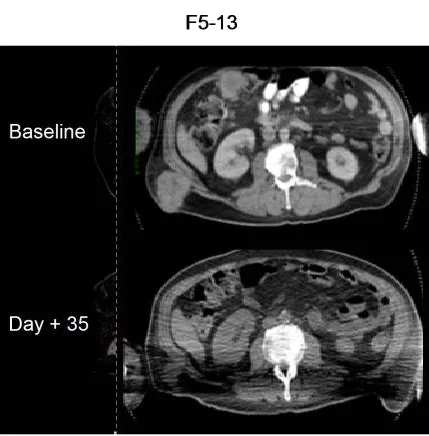TCR-T联合DC疫苗治疗黑色素瘤的效果