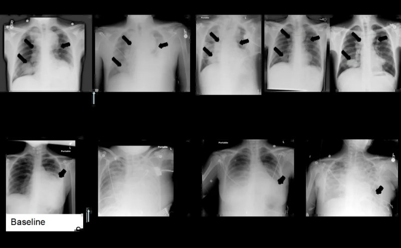 TCR-T联合DC疫苗治疗黑色素瘤肺转移灶的效果