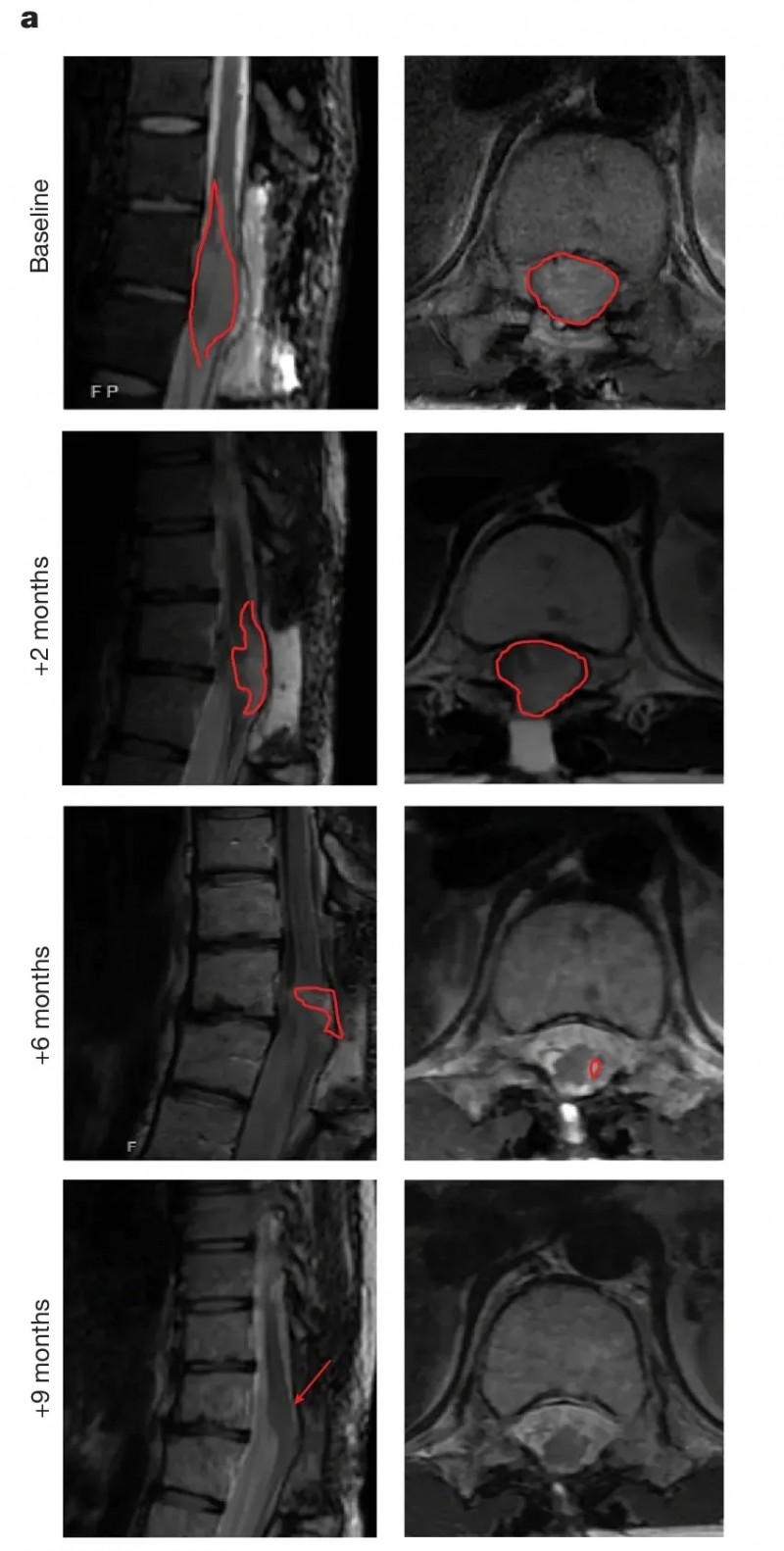 GD2 CAR-T细胞疗法治疗脊髓弥漫性中线胶质瘤的效果