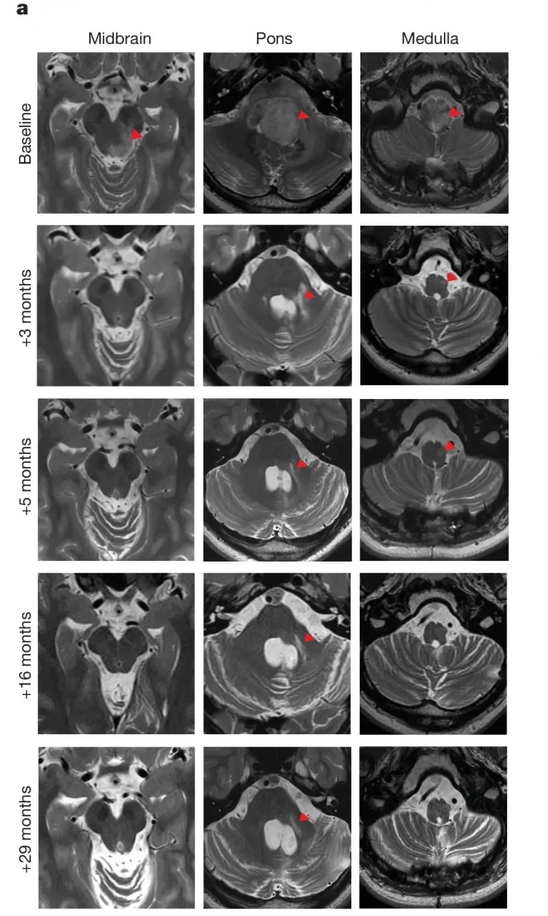 GD2 CAR-T细胞疗法治疗脑桥弥漫性中线胶质瘤的效果
