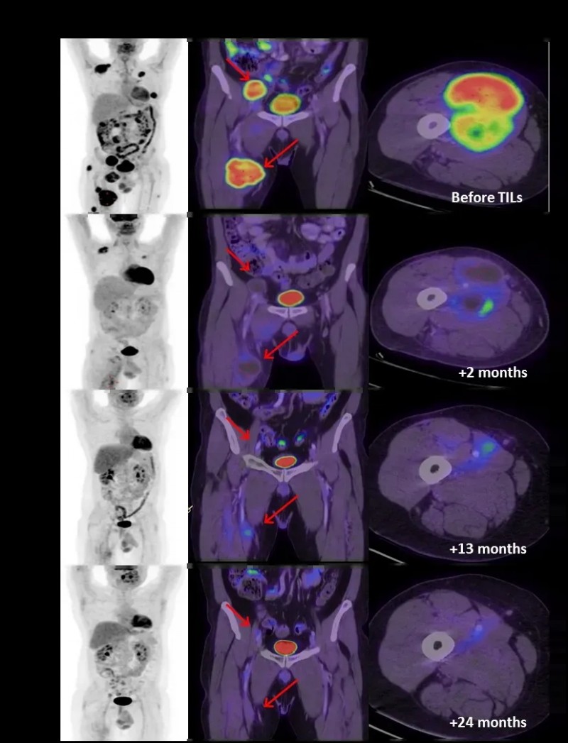 TIL细胞疗法联合低剂量白介素2治疗黑色素瘤的效果