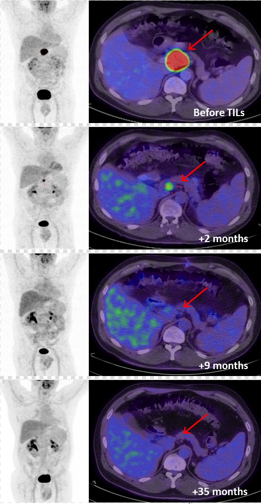 TIL细胞疗法联合低剂量白介素2治疗黑色素瘤的效果