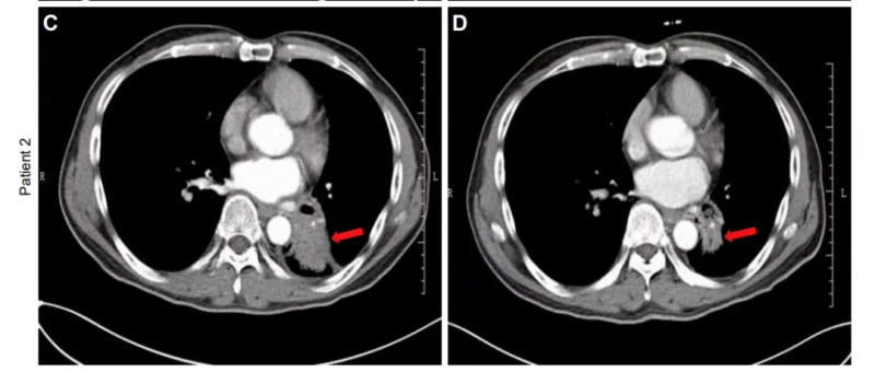 NK细胞疗法治疗非小细胞肺癌的案例