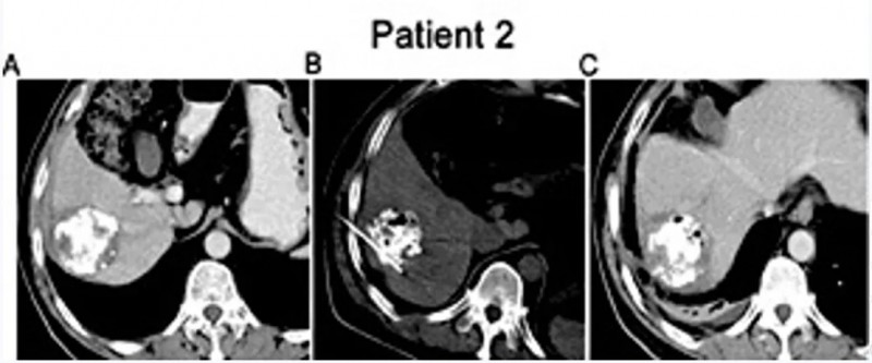 NK细胞疗法治疗IV期肝细胞癌的案例