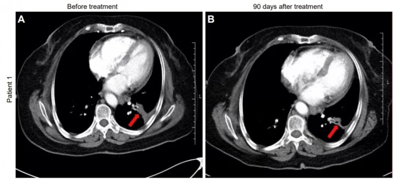 NK细胞疗法治疗非小细胞肺癌的案例