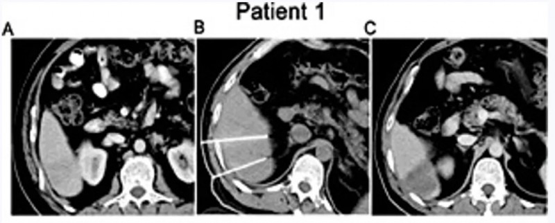 NK细胞疗法治疗IV期肝癌的案例