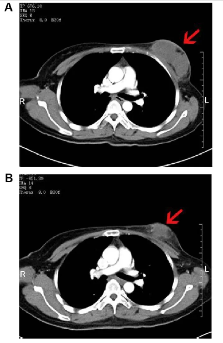 NK细胞疗法治疗乳腺癌的案例
