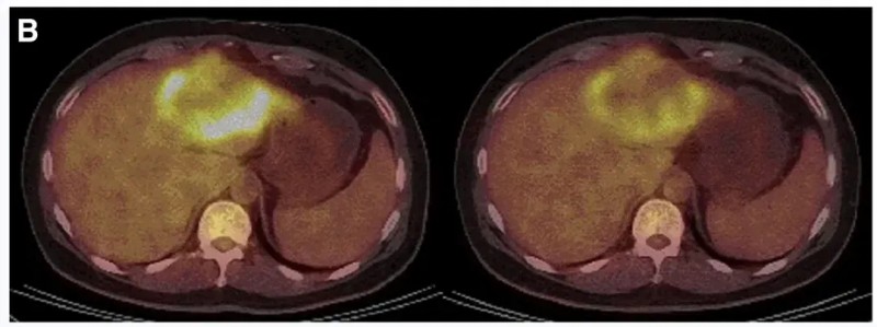 CEA CART细胞疗法治疗结直肠癌的效果