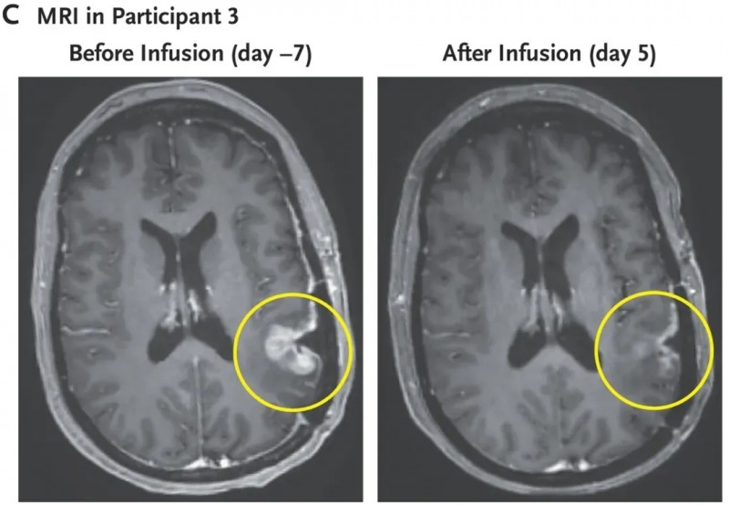 CARv3-TEAM-ET细胞疗法治疗胶质母细胞瘤的效果