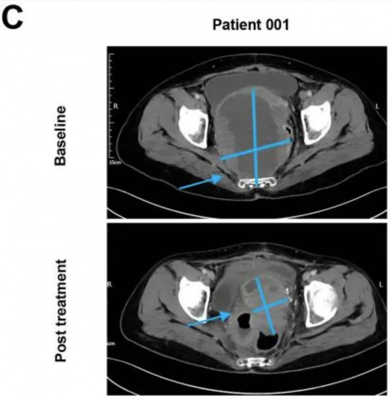 靶向间皮素的CART细胞疗法治疗卵巢癌的效果