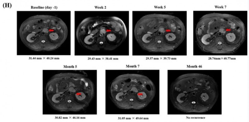 GPC3 CART细胞疗法治疗晚期肝癌的效果