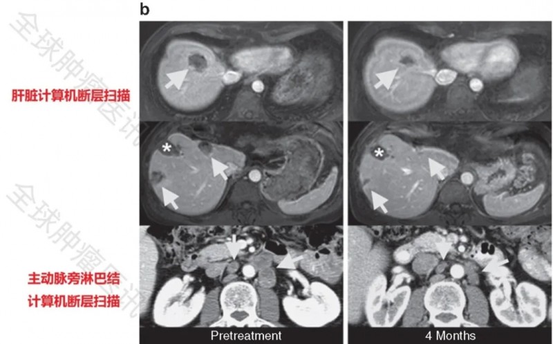 靶向CEA的TCR-T细胞疗法治疗转移性结直肠癌的效果