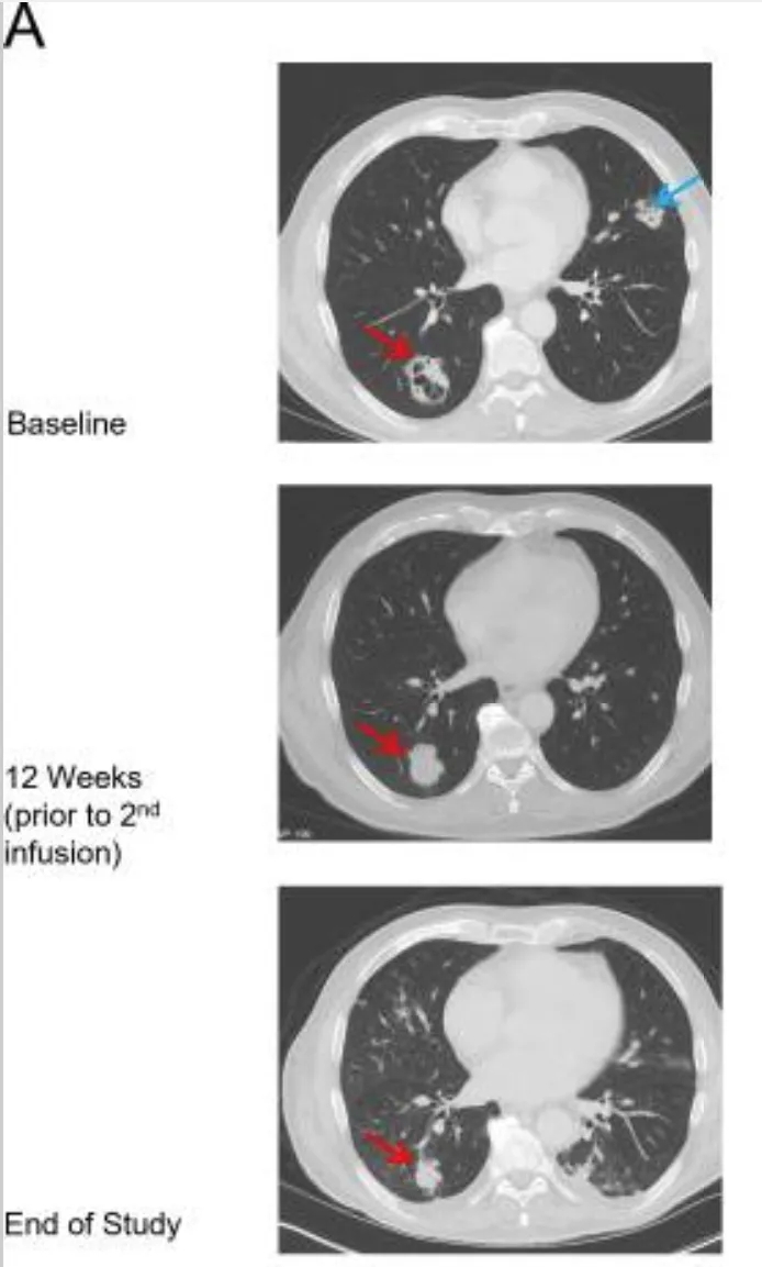 ADP-A2M10T治疗非小细胞肺癌的效果