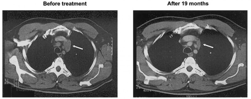 γδT细胞治疗淋巴瘤的效果