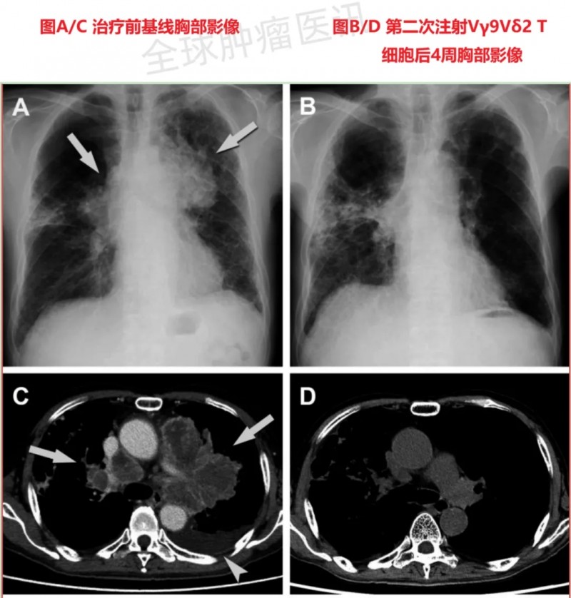 Vγ9Vδ2T细胞治疗非小细胞肺癌的效果