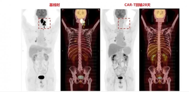 三靶点CART细胞疗法治疗淋巴瘤的效果
