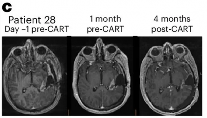 双靶点CART细胞疗法治疗胶质瘤的效果