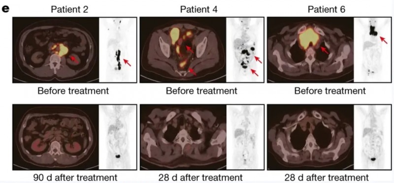 BRL-201治疗淋巴瘤的效果