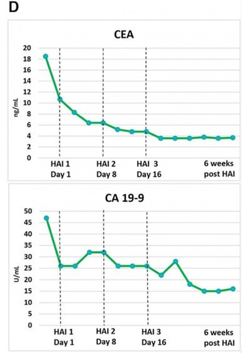 CEA CAR-T治疗胰腺癌肝转移的是数据