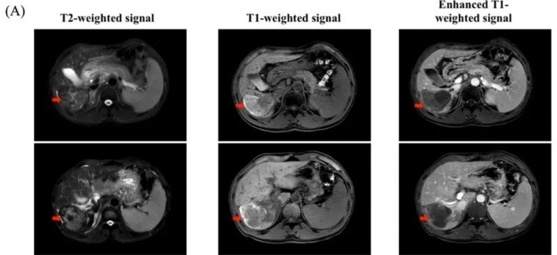 GPC3 CAR=T治疗肝癌的效果